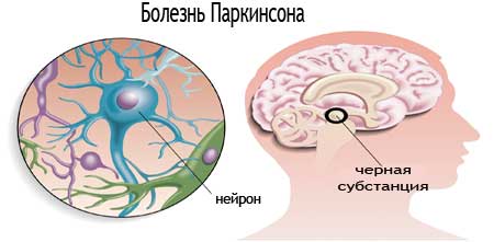 причины болезни Паркинсона
