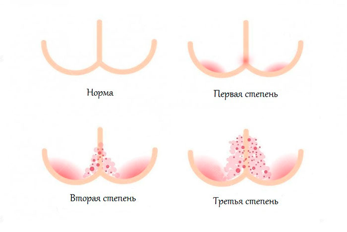 степень опрелости